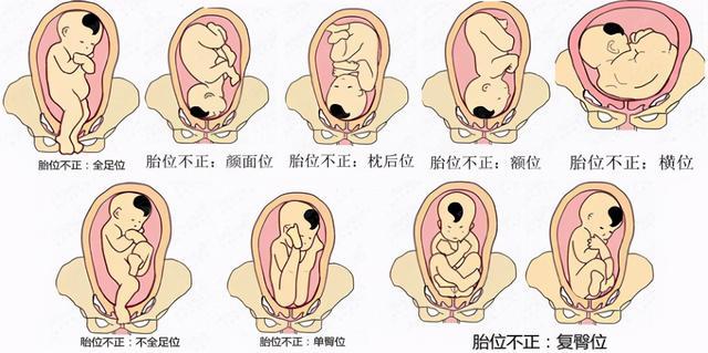 寶寶胎位不正你會看嗎？